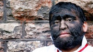 स्पेन में बच्चों को दी पेट दर्द-गैस की दवा, शरीर पर उग आए ढेर सारे बाल Chhattisgarh Crimes