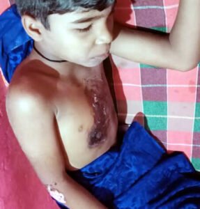 गेम खेलने के दौरान फटा मोबाईल, बच्चा गंभीर रूप से झुलसा Chhattisgarh Crimes