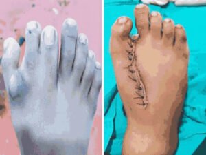 बच्चे के पैर में सात उंगलियां, महिला के दायी ओर धड़क रहा था हार्ट; दोनों ऑपरेशन सफल Chhattisgarh Crimes