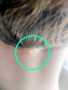 कम बातचीत करने वाले बच्चों के साथ शिक्षिका का बर्ताव अजीब, टोटका करने माचिस की तीली से दाग दी गर्दन Chhattisgarh Crimes