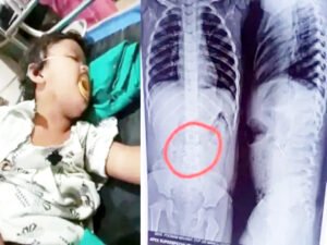 2 साल की बच्ची निगल गई 3 सुई, डॉक्टरों ने एंडोस्कोपी से निकाला बाहर Chhattisgarh Crimes