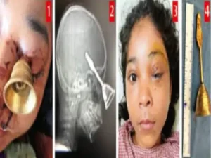 जटिल सर्जरी कर बच्ची और आंख दोनों को बचाया Chhattisgarh Crimes