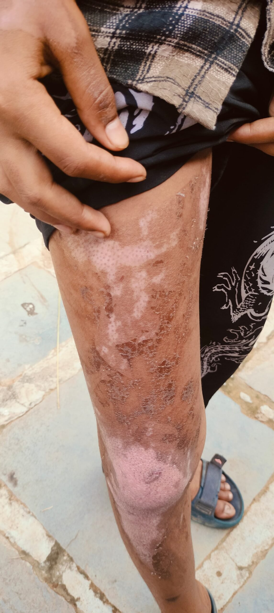 रसोई में नाबालिग बच्चे, कुकर ब्लास्ट में झुलसे दो छात्र! Chhattisgarh Crimes